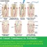 root canal treatment,rct treatment
