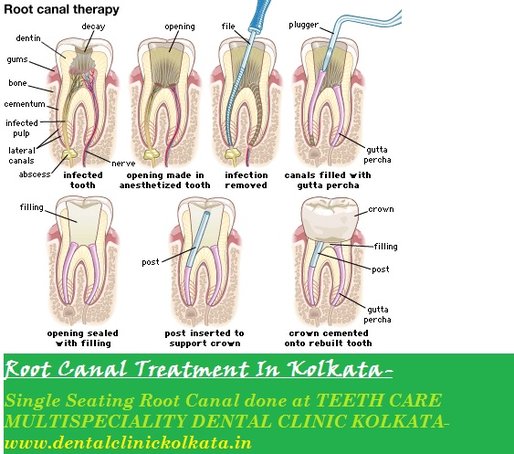 root canal treatment,rct treatment