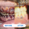 Teeth whitening,dental clinic kolkata